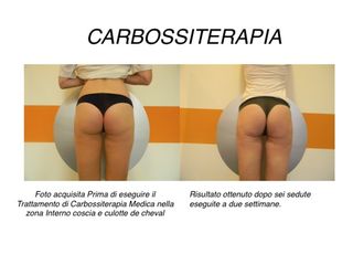 Carbossiterapia Medica prima e dopo