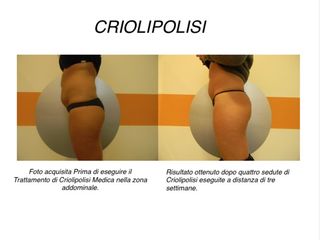 Criolipolisi Medica Addome