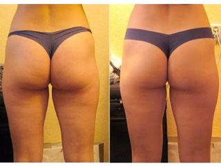 Cellulite prima dopo