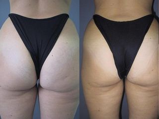 liposcultura prima dopo