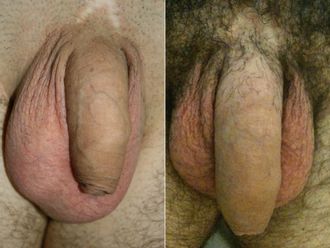 Ingrossamento pene prima e dopo - 880879