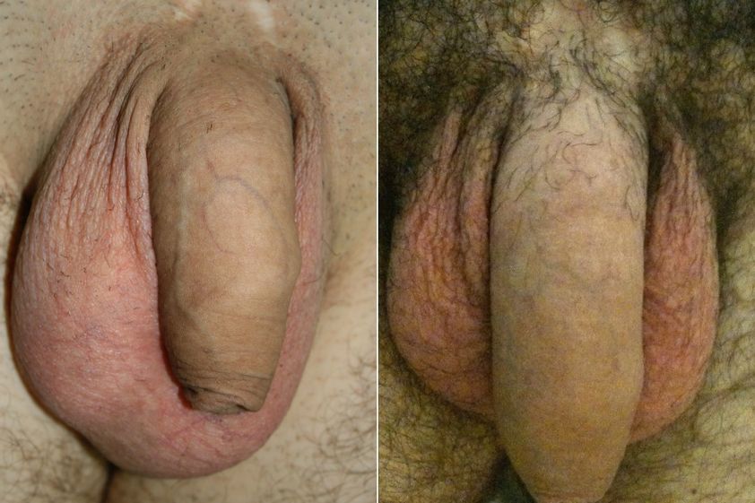Ingrossamento pene prima e dopo - 880879