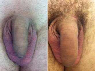 Ingrossamento pene prima e dopo - 880881