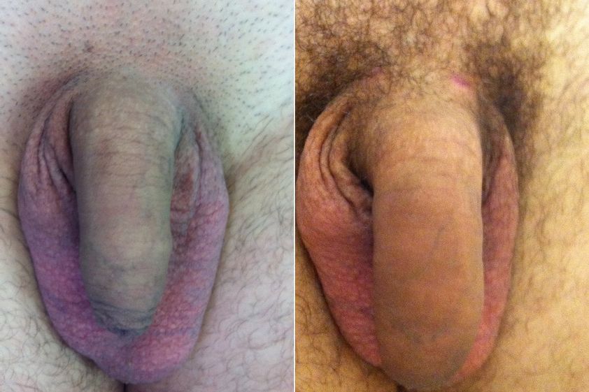 Ingrossamento pene prima e dopo - 880881