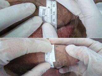 Ingrossamento pene prima e dopo - 880882