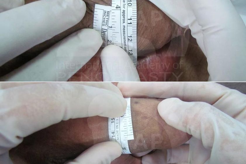 Ingrossamento pene prima e dopo - 880882