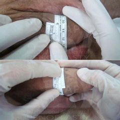 Dott. Alessandro G. Littara Lipopenoscultura (ingrossamento del pene)