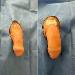 Dott. Alessandro G. Littara pre e post-procedura penisfiller