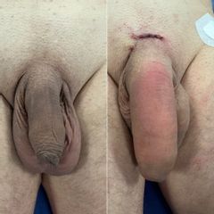 Dott. Alessandro G. Littara falloplastica combinata con tecnica mini invasiva