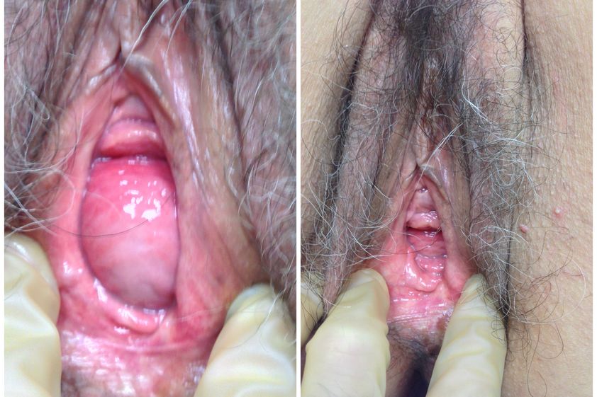 Ringiovanimento vaginale laser prima e dopo - 795189