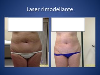 Laserlipolisi prima e dopo