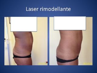 Laserlipolisi prima e dopo