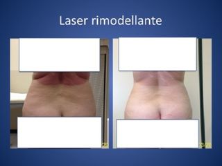 Laserlipolisi prima e dopo