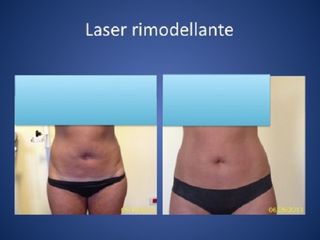 Laserlipolisi prima e dopo