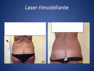Laserlipolisi prima e dopo