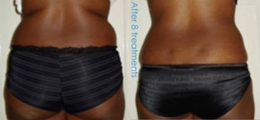 Laserterapia - Easy dieta