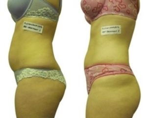 Laserterapia - Easy dieta
