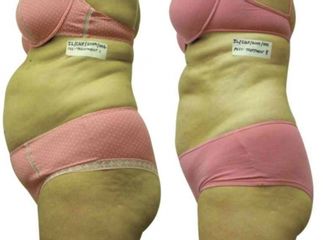 Laserterapia - Easy dieta