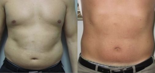 Laserterapia - Easy dieta