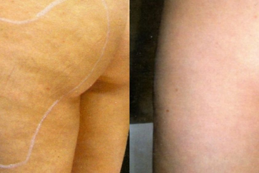 Mesoterapia prima e dopo - 823651