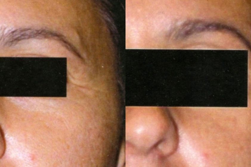 Mesoterapia prima e dopo - 823652
