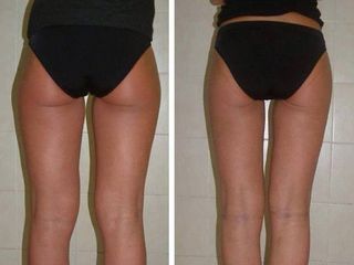 Velashape prima e dopo