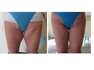 Lifting Interno Cosce prima dopo