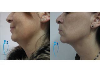 Liposcultura collo prima dopo