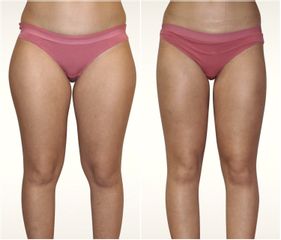 Liposuzione  - LaCLINIC® Napoli