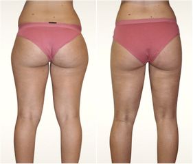 Liposuzione  - LaCLINIC® Napoli