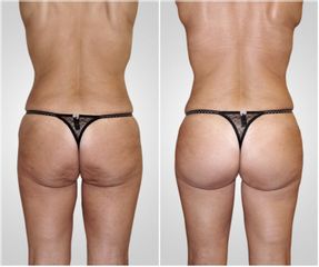 Liposuzione  - LaCLINIC® Napoli
