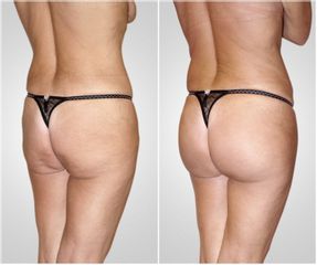 Gluteoplastica - LaCLINIC® Napoli