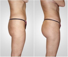 Gluteoplastica - LaCLINIC® Napoli