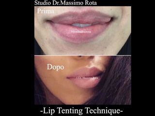 Lip Tenting Technique Prima Dopo 