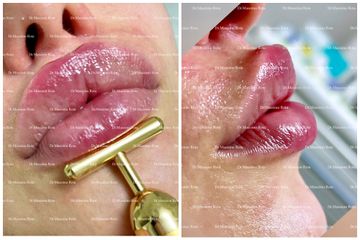 Filler Labbra -Acido Ialuronico - Dr. Massimo Rota