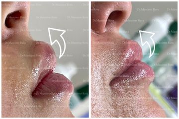 Filler labbra - Dr. Massimo Rota