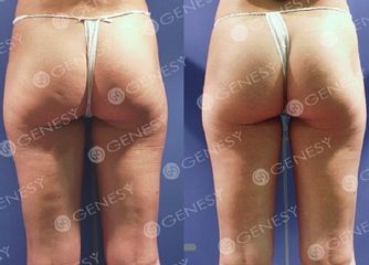 Trattamento cellulite prima e dopo