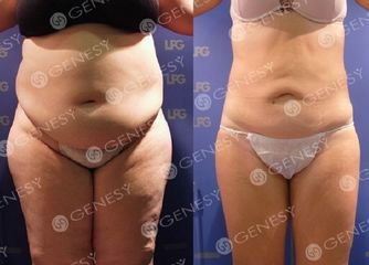 Obesità prima e dopo