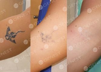 Rimozione laser tatuaggio avambraccio prima e dopo