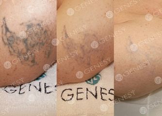 Rimozione laser tatuaggio braccio prima e dopo