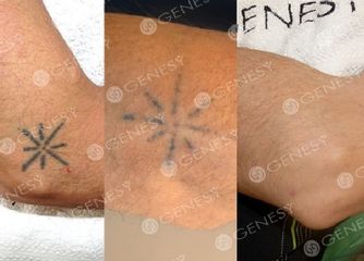 Rimozione laser tatuaggio gomito prima e dopo