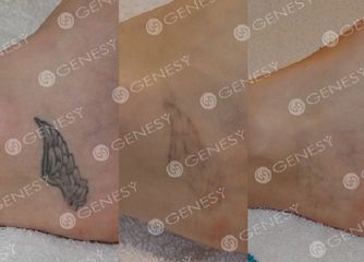 Rimozione laser tatuaggio piede prima e dopo