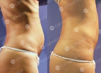 Velashape addome donna prima e dopo