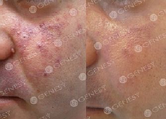 Angioma congenito prima e dopo