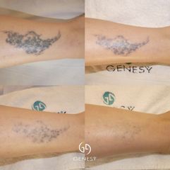 Rimozione tatuaggi - Centro Medico Genesy- Dir. San. Dott. Chemello Fabio