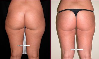 Glutei prima dopo