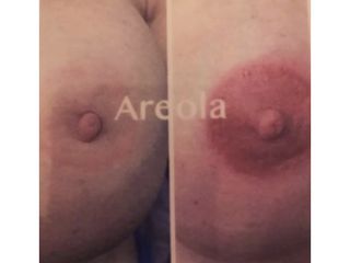 Areola prima e dopo