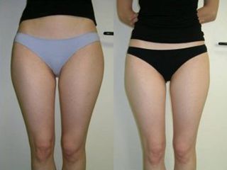 Liposuzione prima e dopo