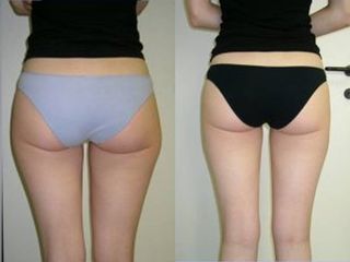 Liposuzione prima e dopo