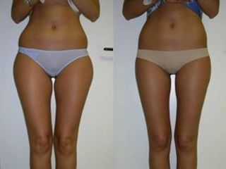 Liposuzione prima e dopo